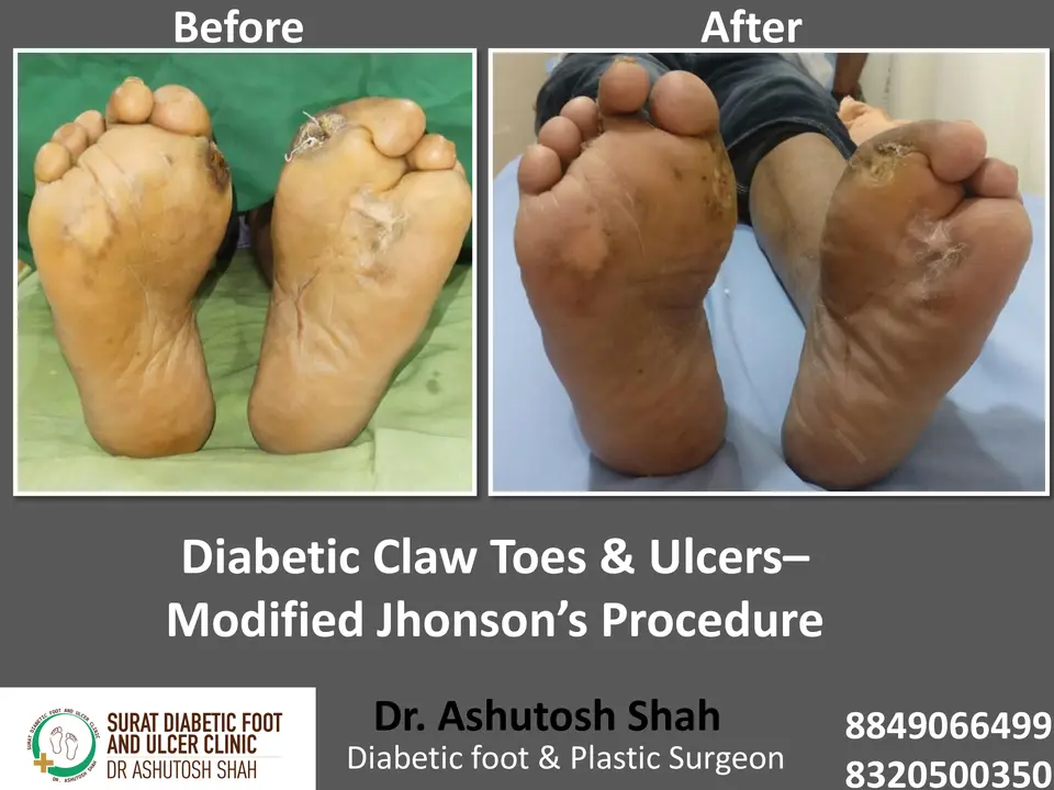 Diabetic Foot  PPT sunita.pptx-24.webp